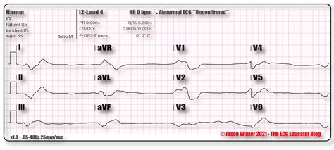 ECG Educator Blog : Agonal Rhythm