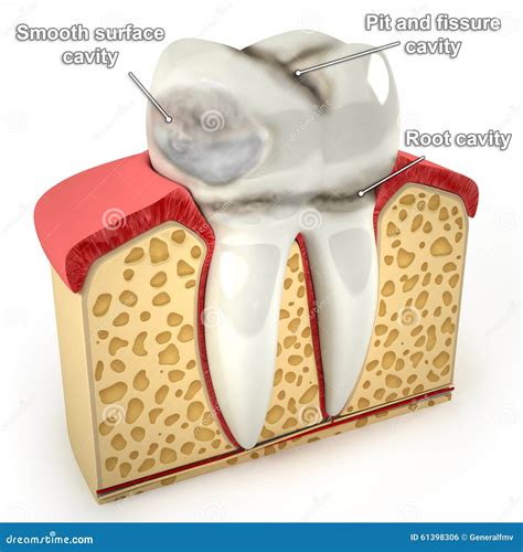 Dental Caries Diagram