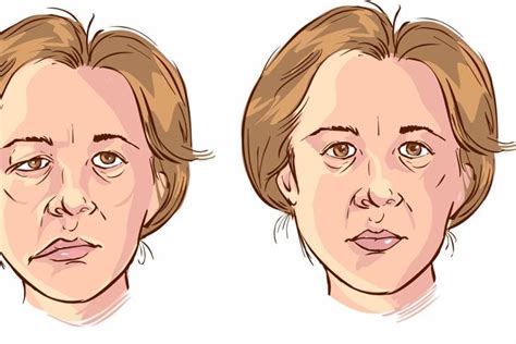 10 Symptoms Of Bells Palsy Facty Health