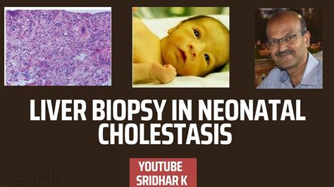 Liver Biopsy To Diagnose Biliary Atresia Liverbiopsy Histopathology