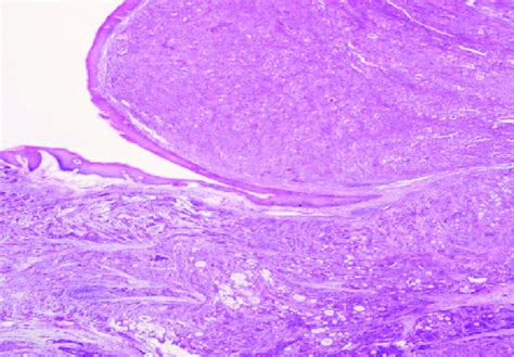 Invasive Moderately To Poorly Differentiated Adenocarcinoma In The Download Scientific Diagram