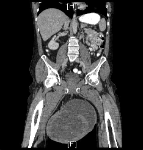 Giant Testicular Seminoma Urology