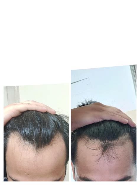 7 Months On Finasteride 1mg Oral And Topical Minoxidil Tressless