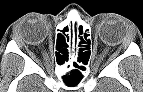 Sarcoidosis Affecting The Lacrimal Gland