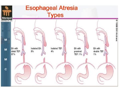 Esophageal Atresia Epitome Of Modern Surgery