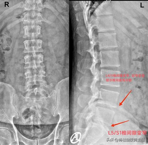 腰部伴下肢疼痛麻木，腰椎間盤突出症，選擇手術還是保守治療？ 每日頭條