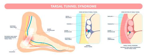 S Ndrome Del T Nel Del Tarso Causas S Ntomas Y Tratamiento