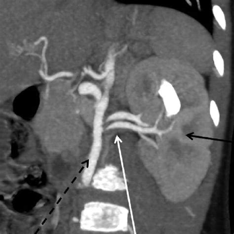 Preoperative Three Dimensional Computed Tomography Showed Two Renal Download Scientific Diagram