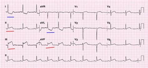 Im Spodn St Ny Ekg Medic Na Nemoci Studium Na Lf Uk