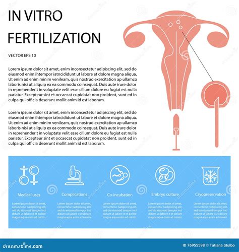 Infographic In Vitro Fertilization Stock Vector Illustration Of