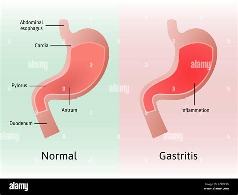 Gastritis Inflamación Irritación O Erosión Del Revestimiento Del