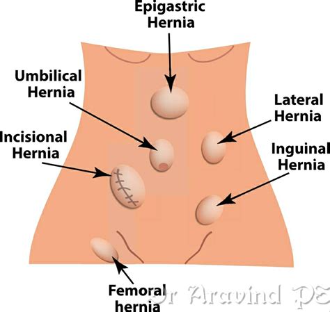 Hernia Dr Aravind Ps Hernia Surgeon In Mysore