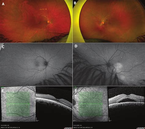 Multimodal Imaging Of The Patient At Presentation Widefield Fundus