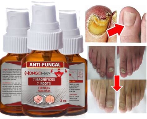 Buy Anti Fungal Treatment Extra Strength Toenail Fungus Fungi Sp Nail