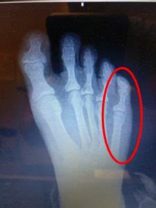 Sprained Pinky Toe or Broken Pinky Toe? [Diagnosis & Best Treatment!]