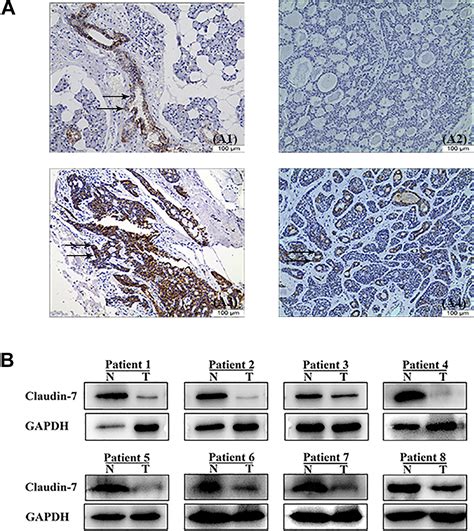 Claudin 7 Inhibits Proliferation And Metastasis In Salivary Adenoid