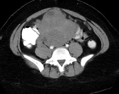 Endometrial Stromal Sarcoma | Diagnostic Imaging