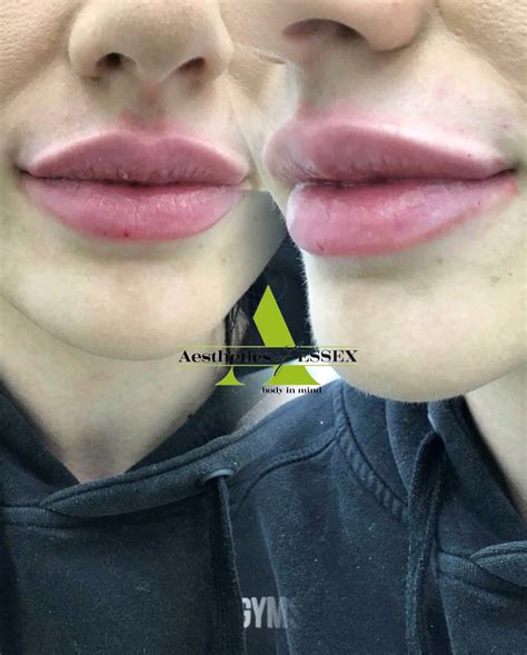 Lip Fillers In Essex Aesthetics Of Essex