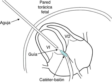 Intervencionismo Cardiaco Fetal Diagnóstico Prenatal