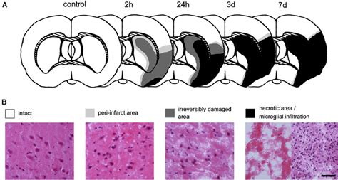 Progression Of The Ischemic Lesion A Anatomic Areas B