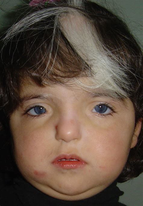 Fetal Alcohol Syndrome Visicom Yahoo Image Search Results Medizin