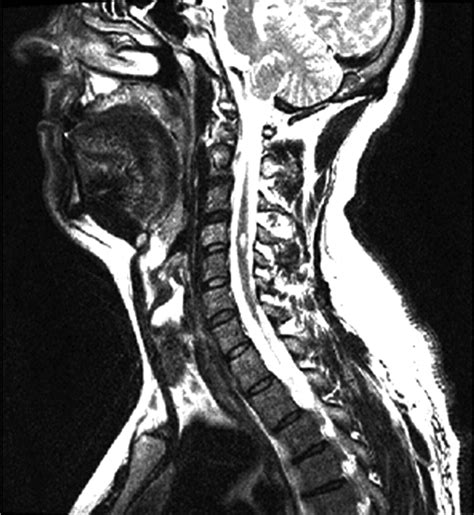 Mr Imaging Of Multiple Sclerosis Radiology