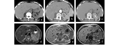 Adrenal CT Protocol Well Defined Small Homogeneous Right Adrenal Mass