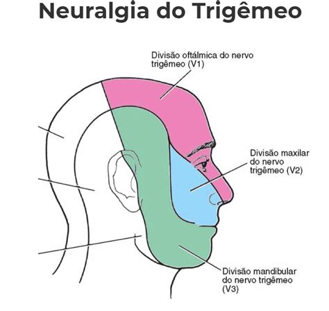 Neuralgia Do Trigêmio Cabeça E Pescoço Londrina