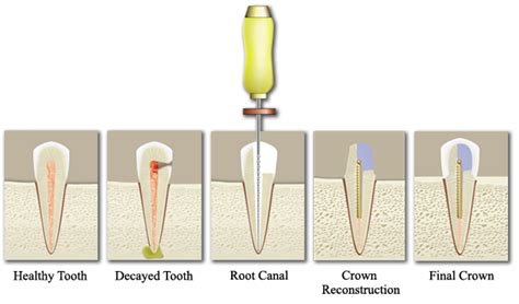 Anterior Root