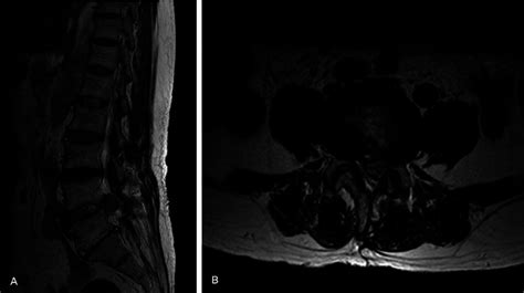 T2 Weighted Sagittal A And Axial B Mr Image Of 54 Years Old Female