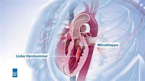 Mitralinsuffizienz Op Medizinische Animation Youtube