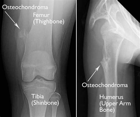 Osteochondroma Causes Symptoms Diagnosis And Osteochondroma Treatment