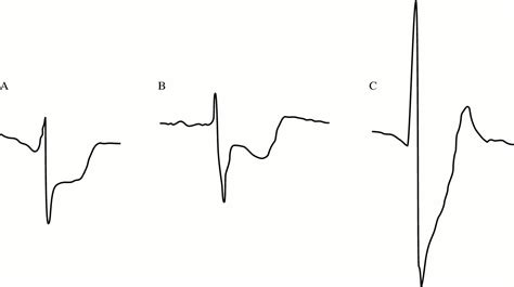 The Electrocardiographic Differential Diagnosis Of St Segment