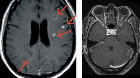 Multiple Sclerosis And Visual Symptoms Emianopsia