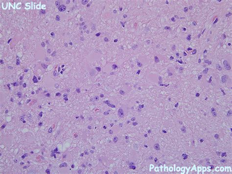 gemistocytic astrocytoma brain histology