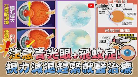 40歲以後經常滑手機小心青光眼和飛蚊症症狀有哪些1情況快就醫 健康2 0 LINE TODAY