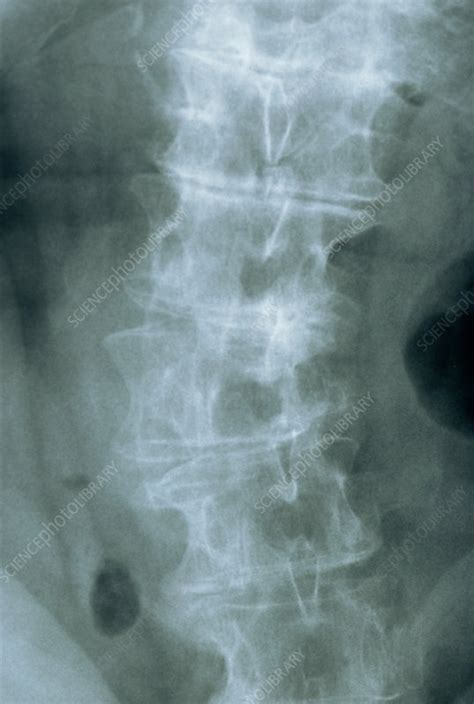 Osteoarthritis Of The Spine X Ray Stock Image M1100522 Science