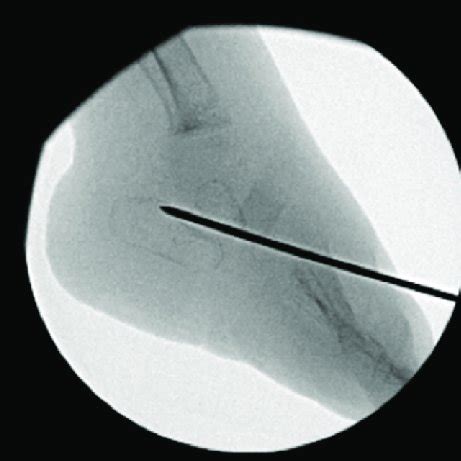 Intraoperative lateral X-ray after reduction of talonavicular joint and ...