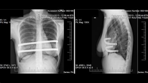 Pectus Excavatum X Ray