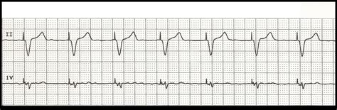 Float Nurse: EKG Rhythm Strip Quiz 100: Paced rhythms