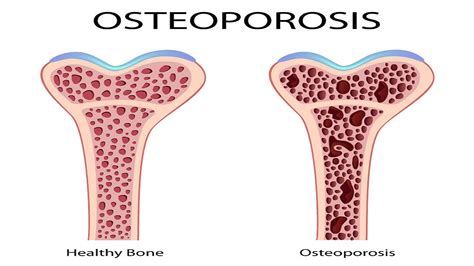 Osteoporosis Causes Diagnosis Treatment And Prevention Gary Kraus Md Back And Neck Houston