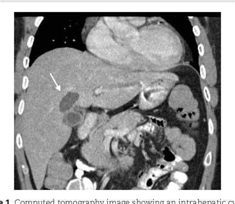 Figure 1 From Choledochal Cysts Type Vi Biliary Cyst Of The Cystic Duct With Connecting To