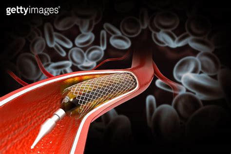 Balloon angioplasty procedure with stent in vein 3d illustration 이미지