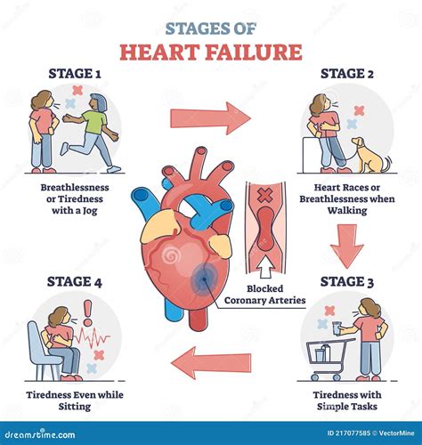 Stages Of Heart Failure And Symptoms With Cardiology Stroke Outline ...