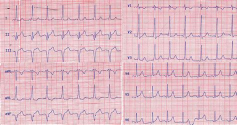 The Image Illustrates The Initial 12 Lead Surface Electrocardiogram Of Download Scientific