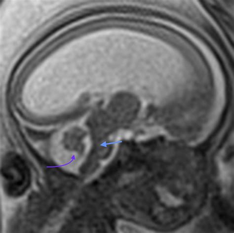 X Linked Hydrocephalus With Adducted Thumb Image