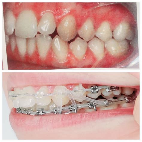 Posterior Open Bite Caused By Braces Rbraces