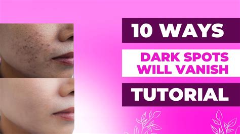 10 Proven Ways To Get Rid Of Dark Spots For Clearer Skin Chicfizz Youtube