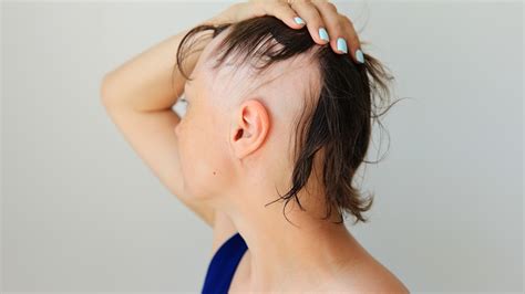 What Is Alopecia And What Causes It?