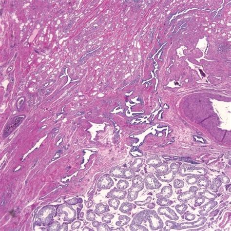 Pdf Adenomatoid Tumor Of Testis